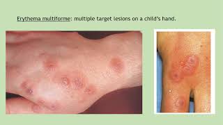 Lecture41 Erythema Multiforme SJ Syndrome and Toxic Epidermal Necrolysis Rooks chapter 47119 [upl. by Hall923]