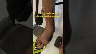 Pitting Edema in Action A Clear SelfDemo [upl. by Verne]