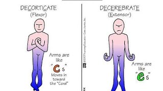 Differences between Decorticate Posturing and Decerebrate Posturing [upl. by Geffner]