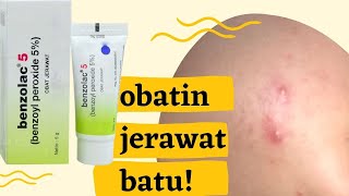 OBAT JERAWAT BATU BENZOLAC  Anis kencana [upl. by Dorelia302]