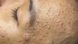 ACNE TREATMENT VU QUYNH MI Acne On Teens Cheek 2024 [upl. by Lashoh]