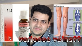 Homeopathic medicine for varicose veins explain [upl. by Nomae]