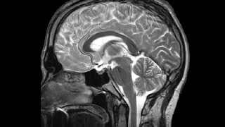 The Ventricles Neuroanatomy Video Lab  Brain Dissections [upl. by Antoni27]