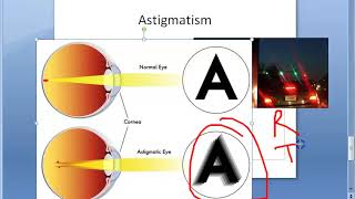 Ophthalmology 044 a Refractive Errors Of Refraction Emmetropia Ametropia Myopia HyperMetropia Eye [upl. by Assej]