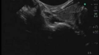 UltrasoundGuided Stellate Ganglion Block [upl. by Wei]