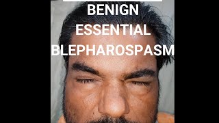 Benign essential blepharospasm BEB shorts [upl. by Joelly]