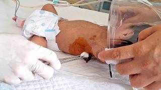 Drainage of MASSIVE Chylothorax in Infant Lung  Medical procedure [upl. by Aileon]