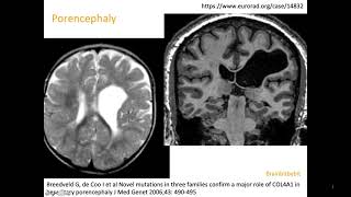 10 Schizencephaly porencephaly COL4A1 mutation congenital CMV open lip closed lip birth defect [upl. by Irrem668]