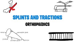 SPLINTS AND TRACTIONS  ORTHOPAEDICS  MED VIDS MADE SIMPLE [upl. by Sklar]