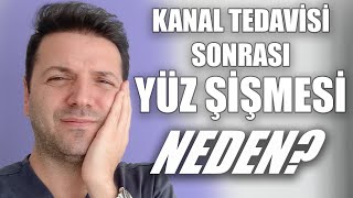 Kanal Tedavisi Sonrasında Neden Yüz Şişer Kanal Tedavisi Sonrasında Ağrı Olur mu Nasıl Yapılır [upl. by Mabel]