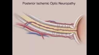 Ischemic Optic Neuropathies [upl. by Slifka]