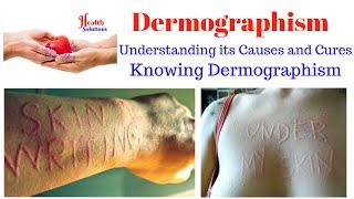 Dermographism – Understanding its Causes and Cures [upl. by Mac70]