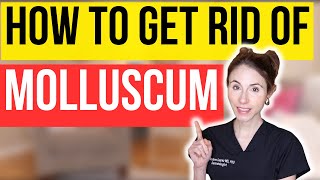 How To Get Rid Of Molluscum FAST  Dermatologist Tips [upl. by Stockton763]