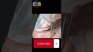 Say Goodbye to Blackheads A StepbyStep Guide acne [upl. by Einaej803]