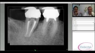 La chirurgie endodontique  le choix de la conservation [upl. by Ennazzus866]